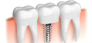 Veltkamp Family Dentistry | Lynden, WA Dentists | Dental Implants Available