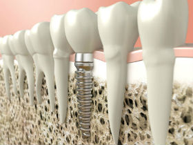 Veltkamp Family Dentistry | Lynden, WA Dentists | Dental Implants