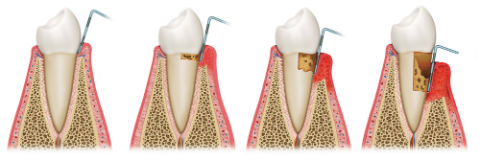 Veltkamp Family Dentistry | Lynden, WA Dentists | Gum Disease Treatment