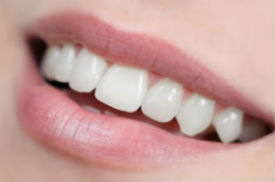 Veltkamp Family Dentistry | Lynden, WA Dentists | Porcelain Veneers